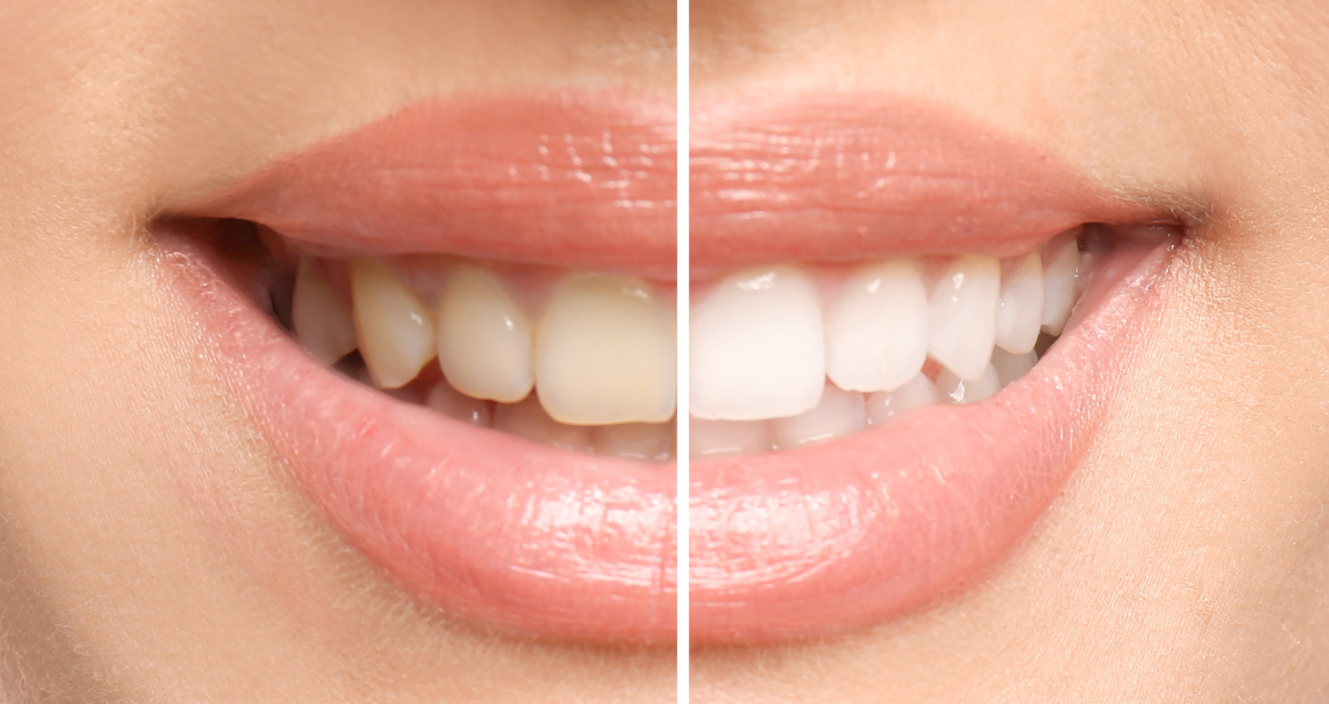 Teeth Whitening in Memorial, Houston