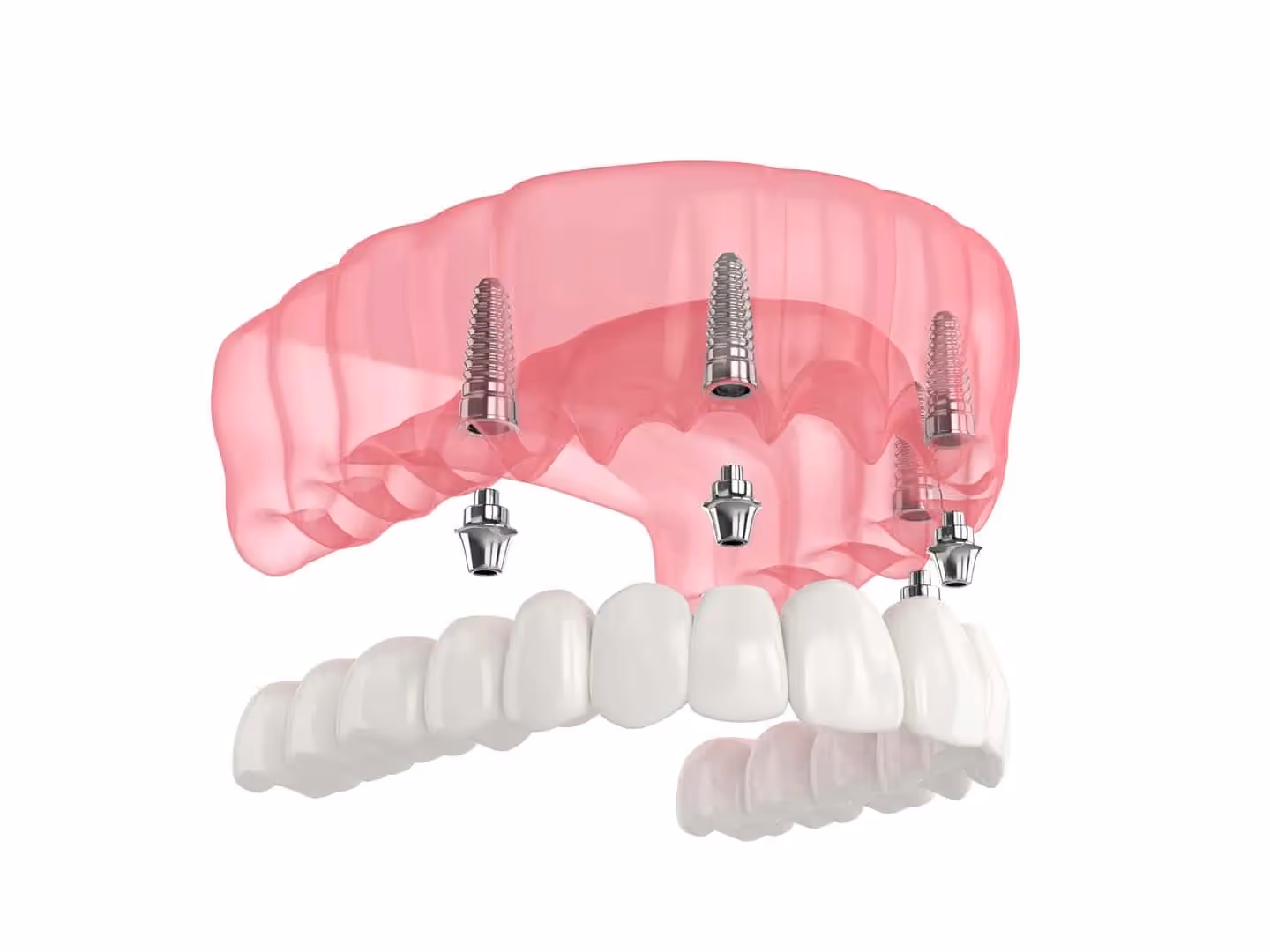 All on 4 Dental Implants in Memorial, Houston